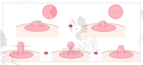 杭州美萊做乳頭縮短推薦栗勇醫(yī)生