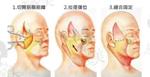 合肥韩美整形美容医院拉皮示意图