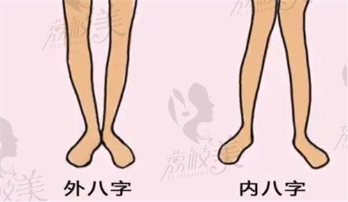 卢九宁医生做直腿成形术的技术特点