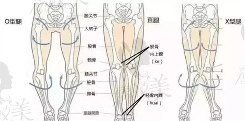 卢九宁医生做直腿成形矫正手术真的好