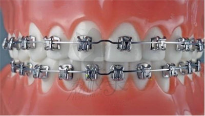 龙小芳医生在牙齿矫正方面的技术优势3