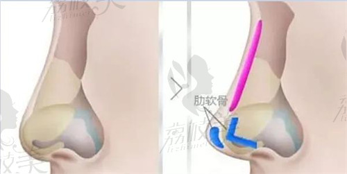 肋软骨隆鼻示意图