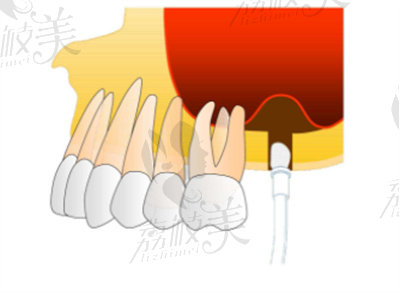姜震醫(yī)生在上頜竇提升方面的技術(shù)優(yōu)勢(shì)2