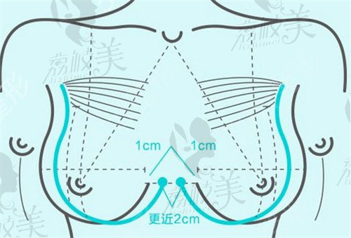 缩胸手术方案设计示意图
