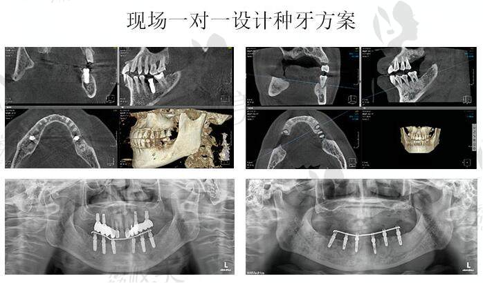 億大口腔種植牙一對一設計方案