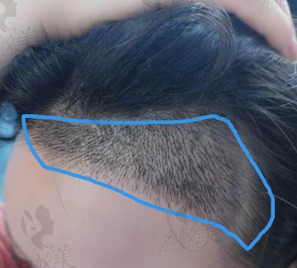 发际线植发后三个月