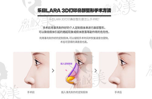 3d打印鼻部整形技术