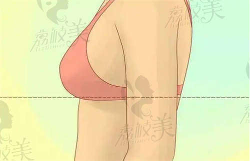 乳房下垂示意图