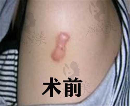 杭州美莱刘明章医生凸出性疤痕取治疗反馈