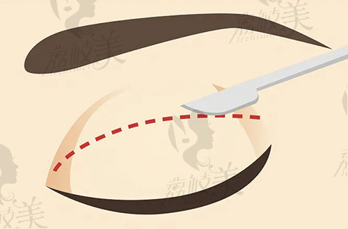 余东医生做的起价5.9w的眼部修复能修复疤痕