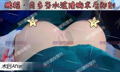 深圳鹏程李子鹏贝多芬水波隆胸术后即刻