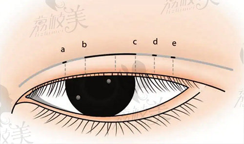 上海美詩(shī)沁醫(yī)療美容的雙眼皮整形特色是什么