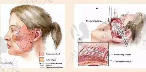 杜太超CAW小切口拉皮提升手术示意图