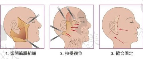 王志堅(jiān)4S TCM組織復(fù)位術(shù)