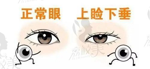 正常眼与上睑下垂眼对比