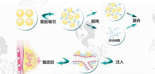 袁純新醫(yī)生自體脂肪隆胸滿意度高