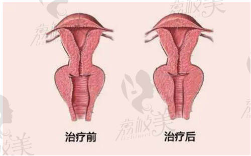 阴道紧缩手术的治疗前后