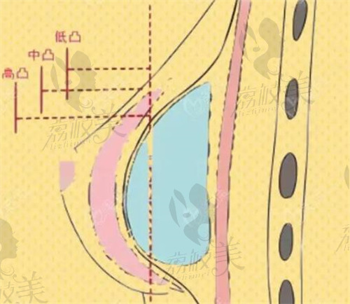 姜南假體隆胸結(jié)構(gòu)示意圖