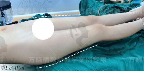 深圳景田万晓楠医生大腿环吸