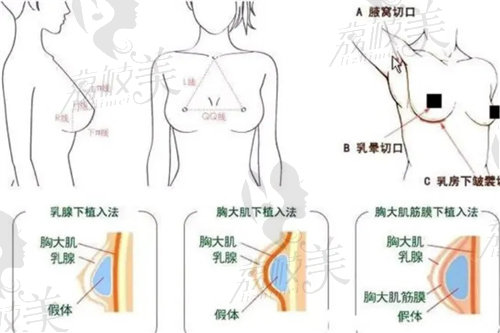 武汉仁爱时光隆胸示意图