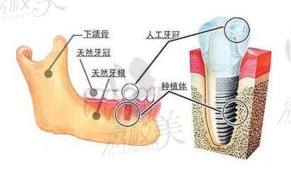 种植牙多少钱一颗2022价格表