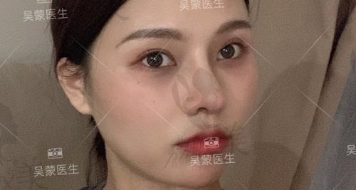 术后十五天