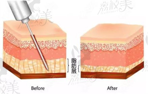 劉乾坤吸脂皮下示意圖