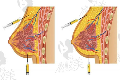 厦门思明臻医自体脂肪隆胸性价比高