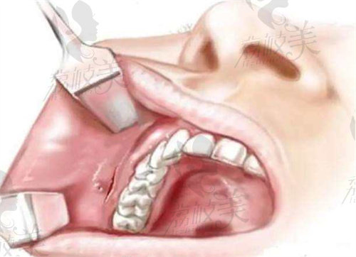 項昌峰下頜角手術(shù)采用口內(nèi)切口