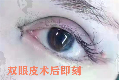 耿向阳医生做双眼皮整形修复技术特色