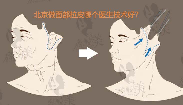 北京做面部拉皮哪个医生技术好？