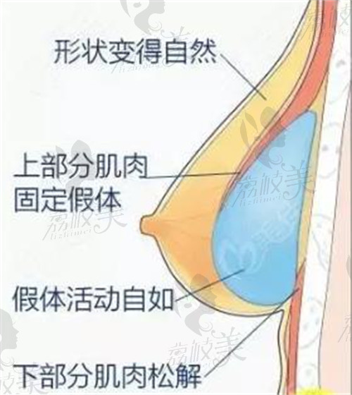 王合珍假體隆胸結(jié)構(gòu)示意圖