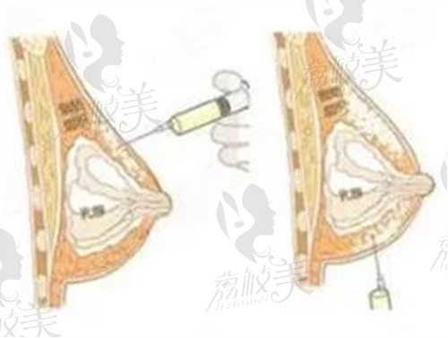 李永峰自體脂肪隆胸示意圖