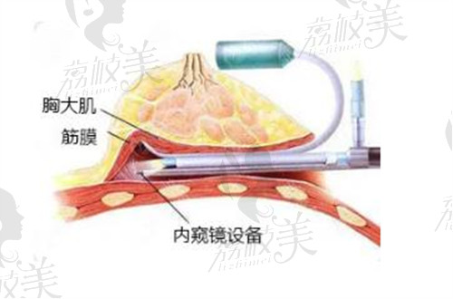 赵亮内窥镜隆胸示意