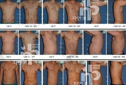 韩国NB整形外科医院腹直肌塑形术