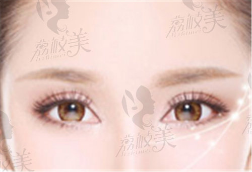 武汉江城整形外科医院双眼皮示例