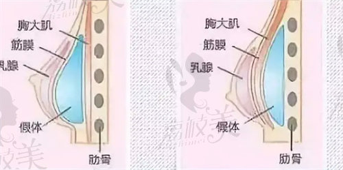 进口曼托假体丰胸