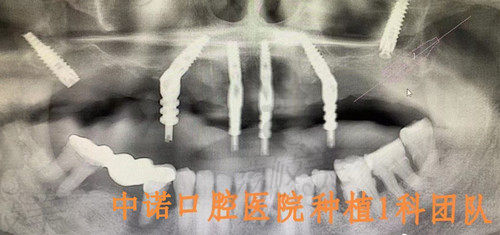 西安中诺口腔医院种植牙病例