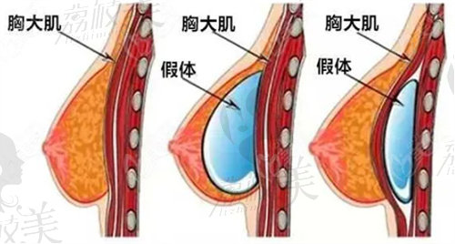 杭州維多利亞的隆胸多少錢？