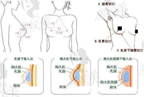 假體隆胸示意圖