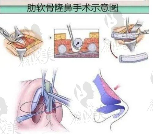 李光琴医生肋软骨隆鼻技术不赖