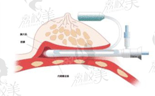 內(nèi)窺鏡隆胸示意