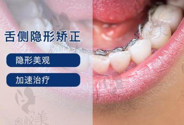 北京冠美口腔医院3D数字舌侧隐形矫正
