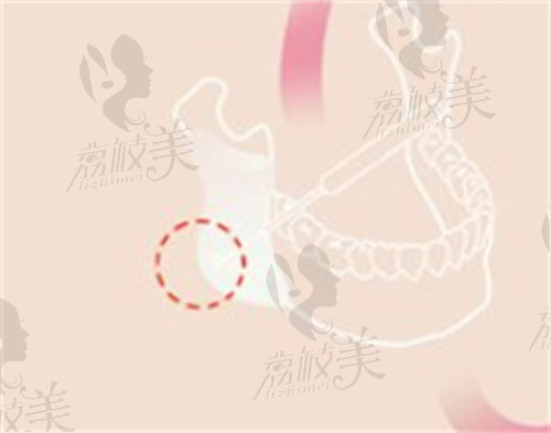 韓國(guó)菲斯萊茵李真秀下頜角手術(shù)