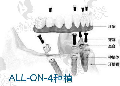 北京地区ALL-ON-4种植牙