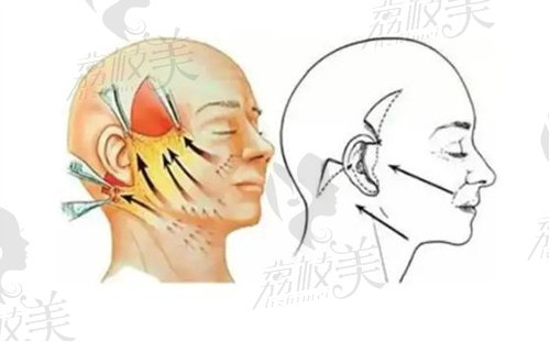 拉皮手術切口及過程展示