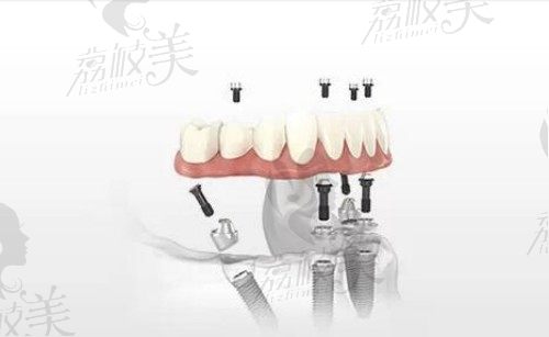 信阳伢牙齿科all-on-4技术