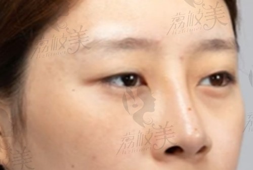 陈丽平医生做双眼皮手术前眼部情况