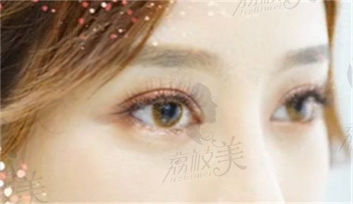 陈丽平医生做双眼皮手术超自然