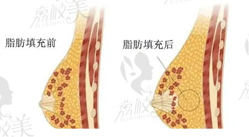 袁純新做自體脂肪豐胸技術(shù)靠譜